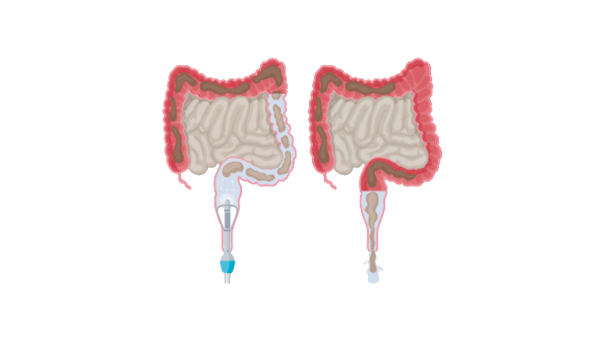 Darmspoelen met Peristeen Plus